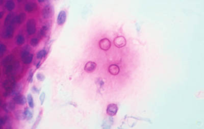 Dendritas Herpéticas