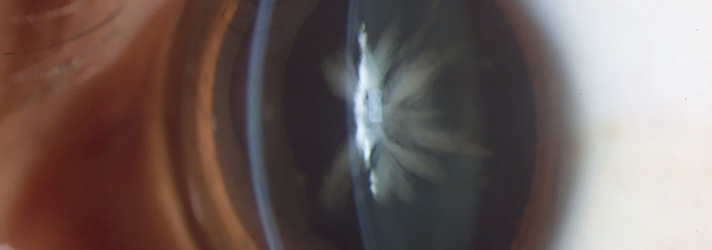 Acanthamoeba